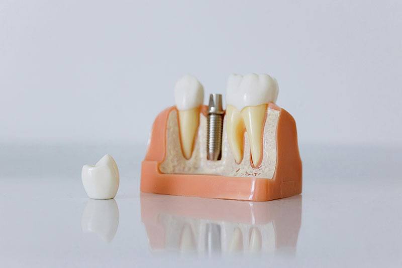 Impianti dentali senza osso